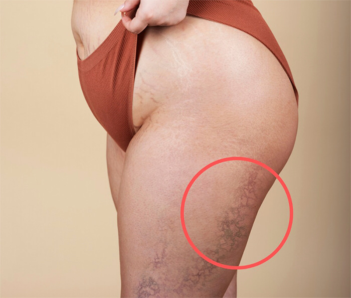 Lipedema - Coolwaves