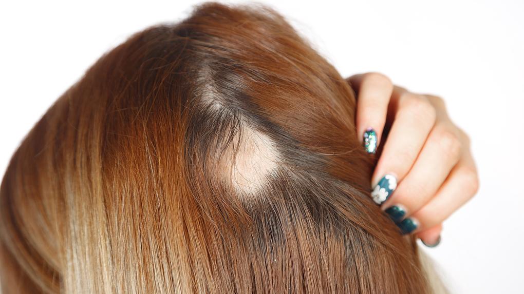 Dra Catia - Alopecia - Tecnologia Red Touch