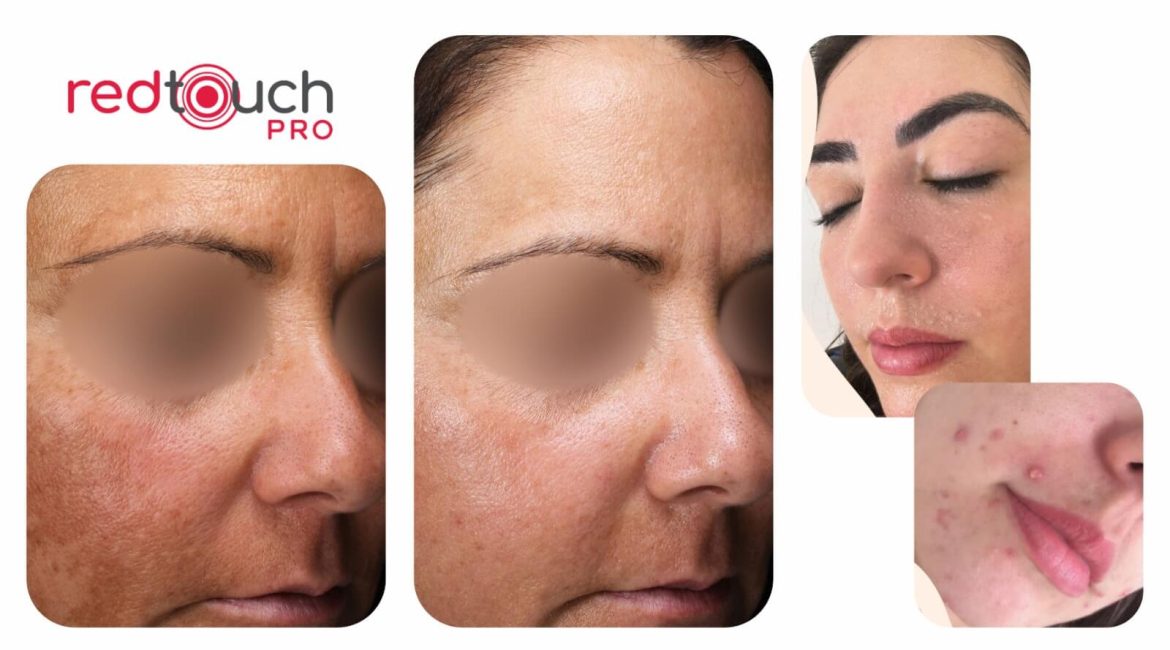 Remover Manchas - Red Touch - Dra Catia Pessanha